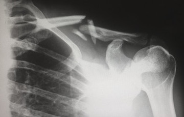 X-Rays (General Radiography)